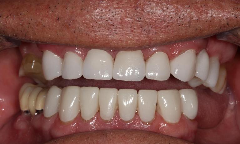 restored smile after ceramic crowns l dentist in farmington nm