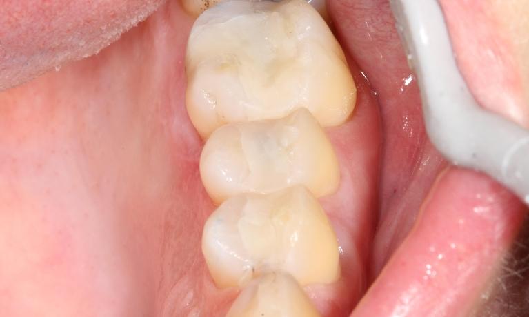 composite fillings after farmington nm