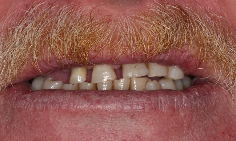 discolored, crooked teeth