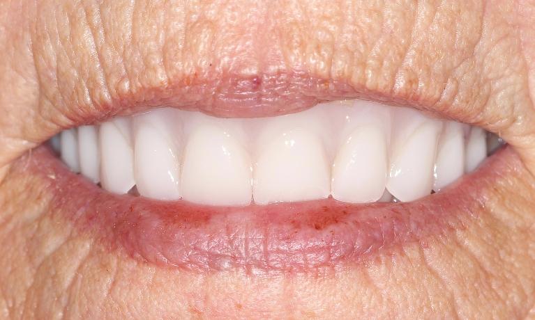 before fittted custom dentures | custom dentures farmington nm