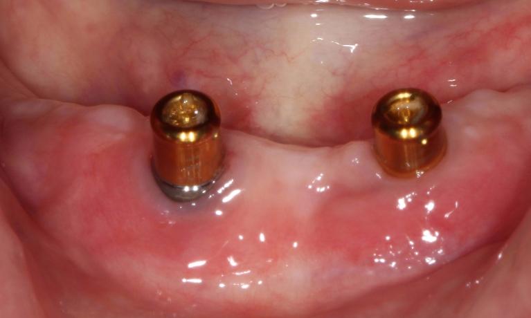 Dental-Implant-Secured-Denture-Before-Image