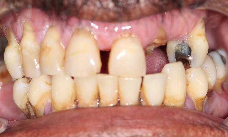 teeth replacement options farmington nm