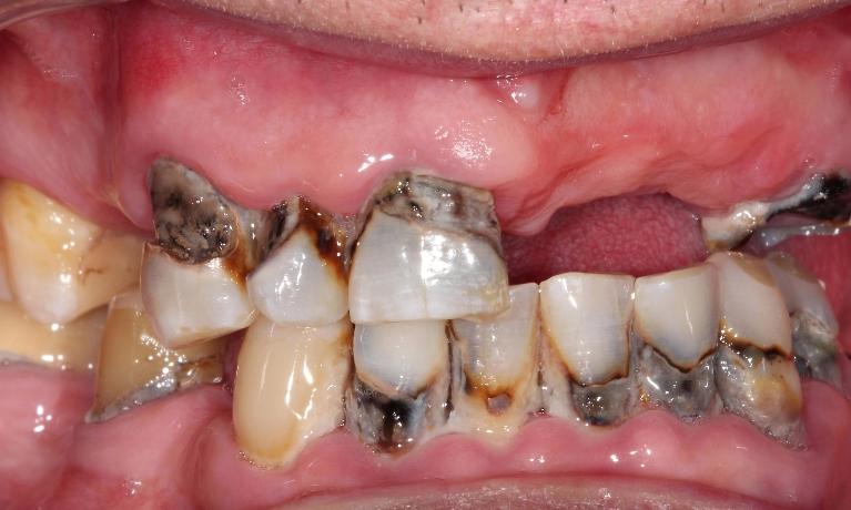 before dentures | full dentures farmington nm