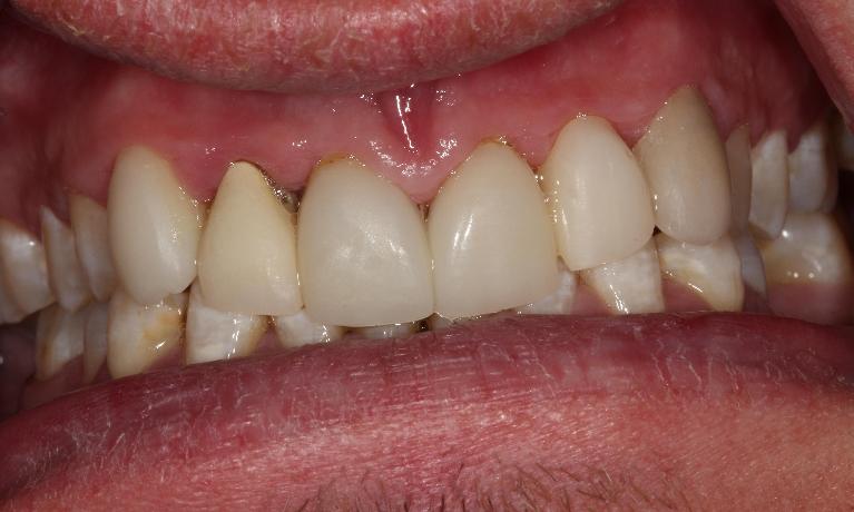 ceramic crowns farmington nm