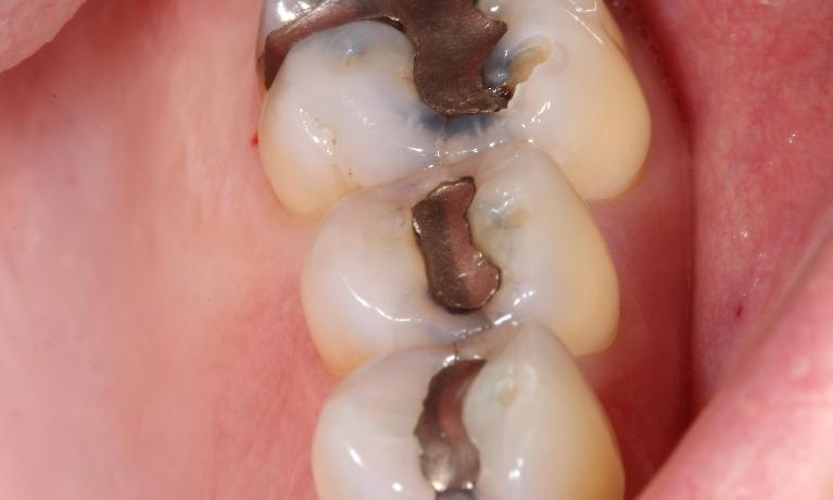 metal fillings before | composite filling farmington nm