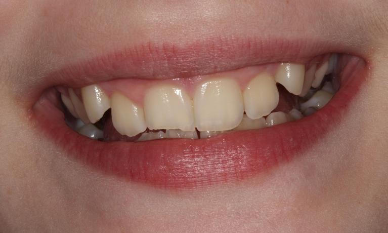 child smiling | before dental bonding farmington nm