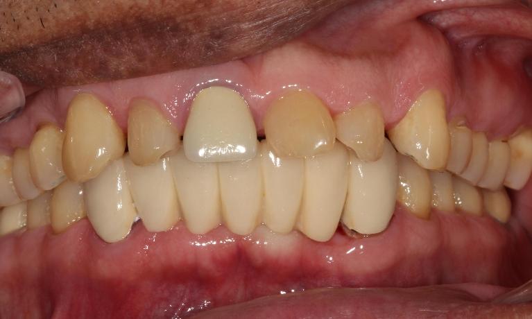 crooked teeth farmington nm